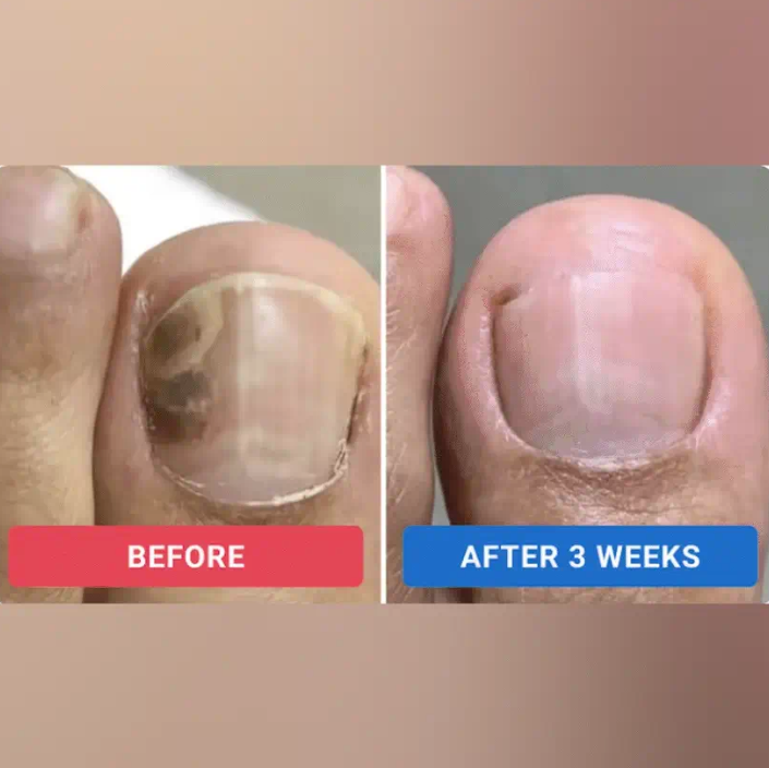 Fungal Fix - Fungal Nail Renewal Patches
